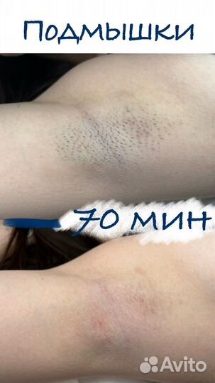 Электроэпиляция: бёдра