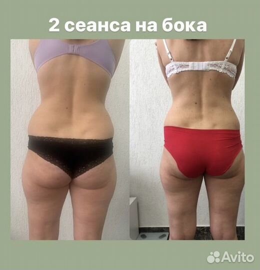 Антицеллюлитный массаж, Липопластика