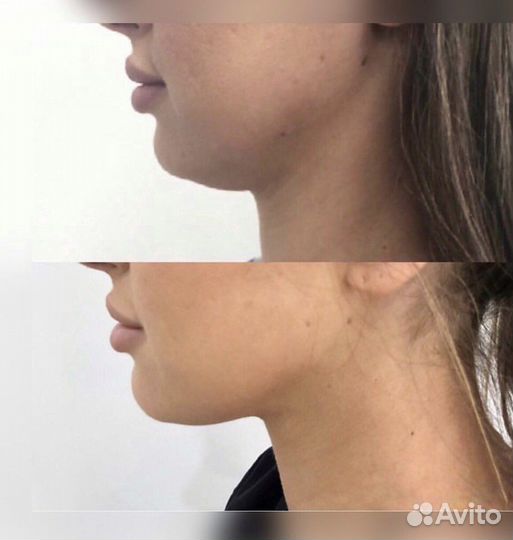 Липолитик, точка голода