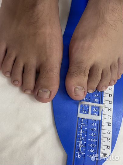 Подолг в Солнцево. Проблемные ногти и пятки