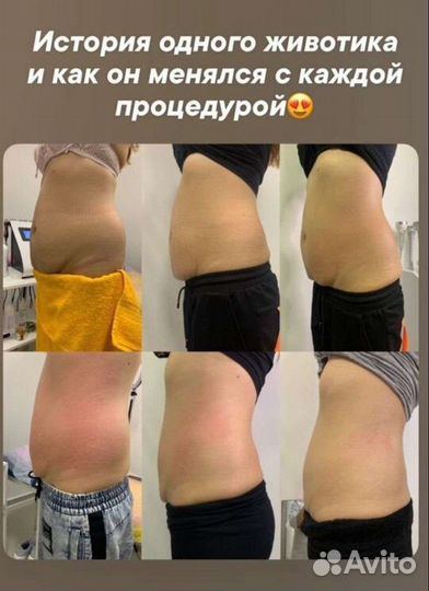 Антицеллюлитный массаж аппаратный