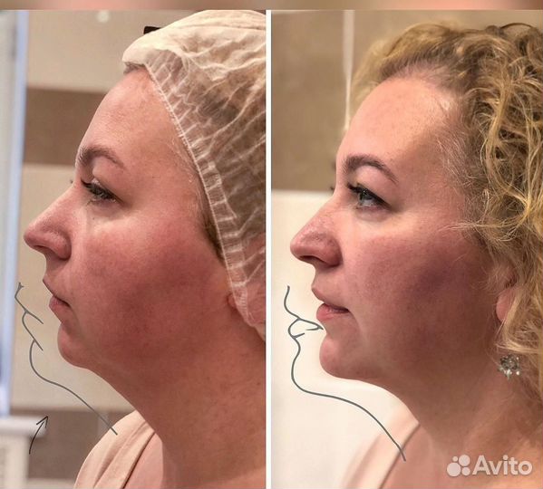 Модели на Удаление Второго Подбородка