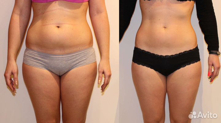 Аппаратный массаж