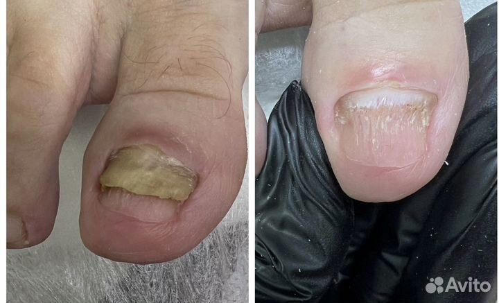 Подолог, педикюр