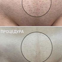 Лазерная эпиляция Ноги полностью+тот.бикини+подмыш, Санкт-Петербург