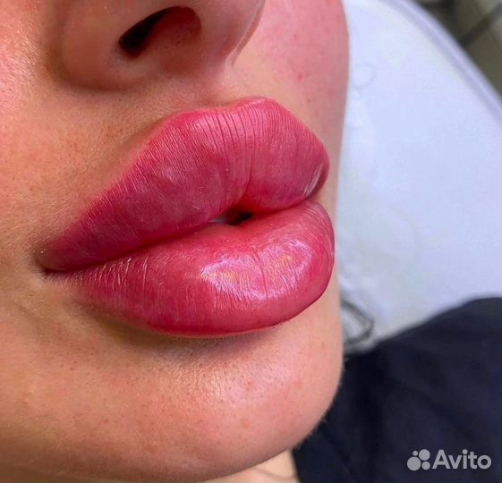 Модель на увеличение губ