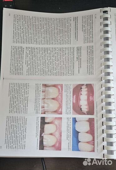 Керамические виниры Галип Гюрель