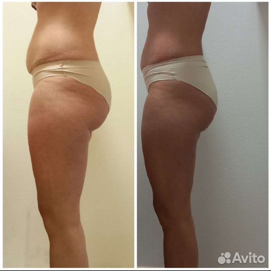 LPG массаж лица и тела на Комендантском проспекте