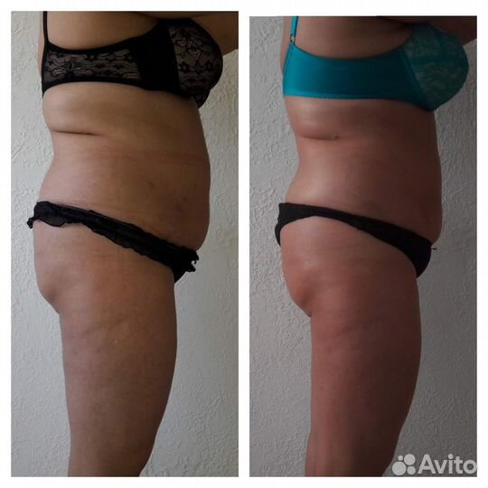 Антицеллюлитный массаж