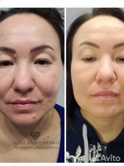 Омоложение