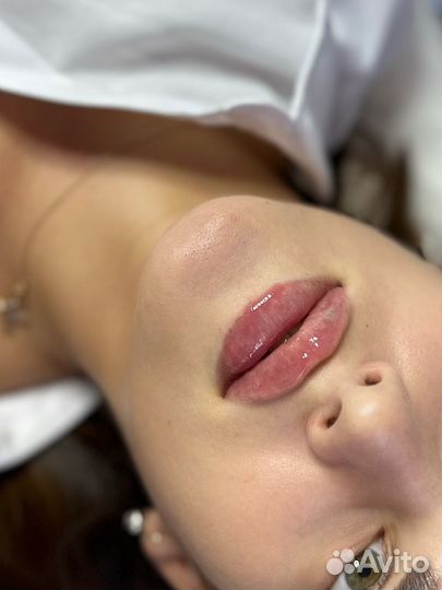 Увеличение губ