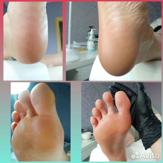 Педикюр подология