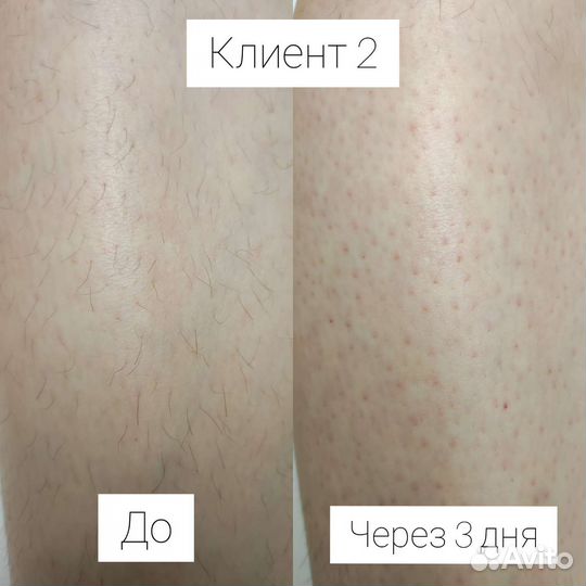 Электроэпиляция: голени