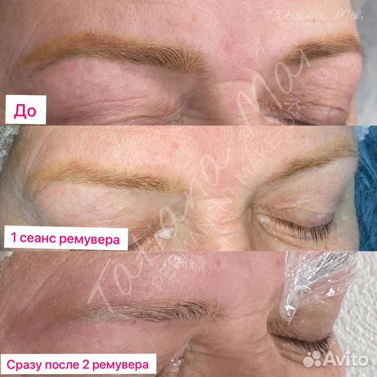 Удаление ремувером татуажа