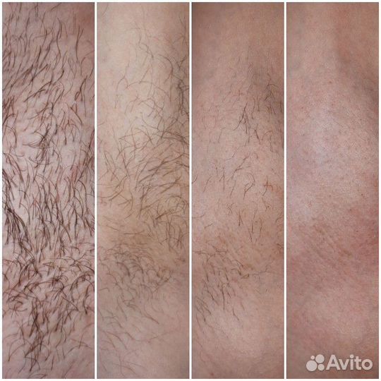 Удаление волос