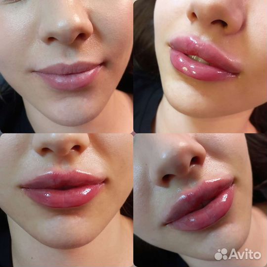 Увеличение губ (контурная пластика)