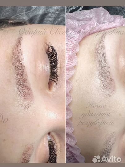 Удаление татуажа ремувером