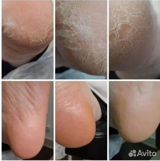 Педикюр,титановая нить,выезд на дом