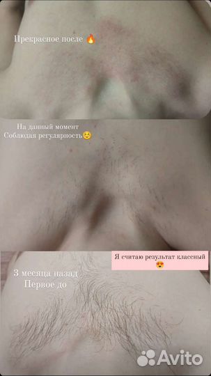 Восковая депиляция