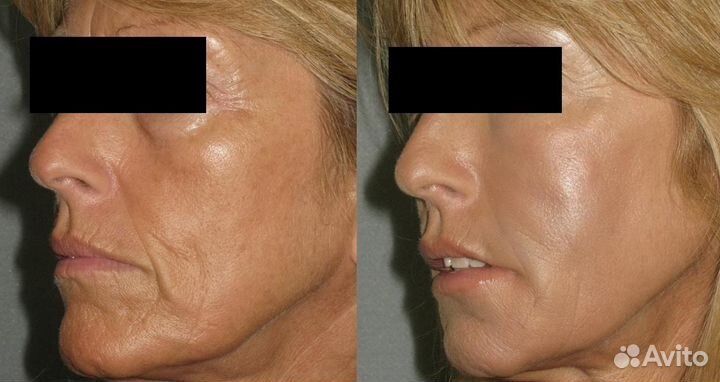 Микроигольчатый РФ