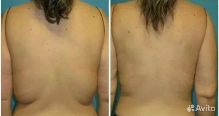 Худеем, Липосоникс, жиротоп