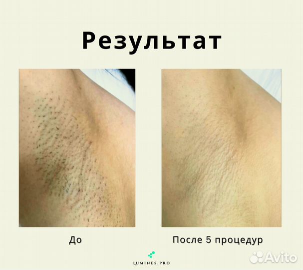 Диодный лазер для эпиляции Лю’минес максван 1200 Вт