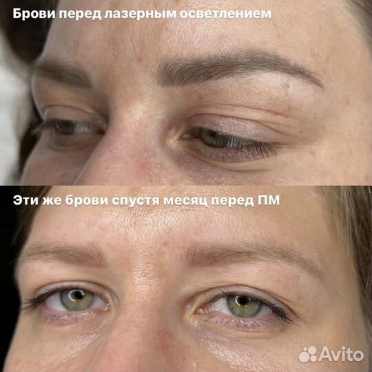 Удаление татуажа