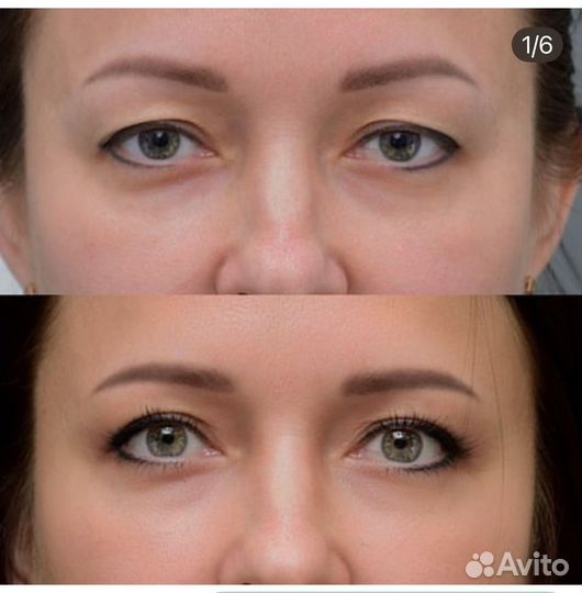 Блефаропластика