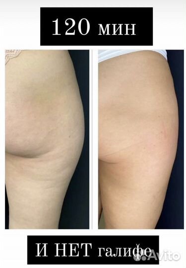 Похудеете аппаратный массаж Скетч