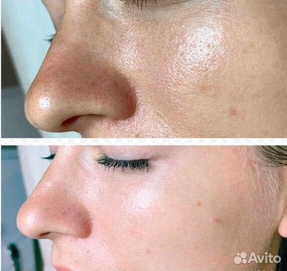 Карбокситерапия