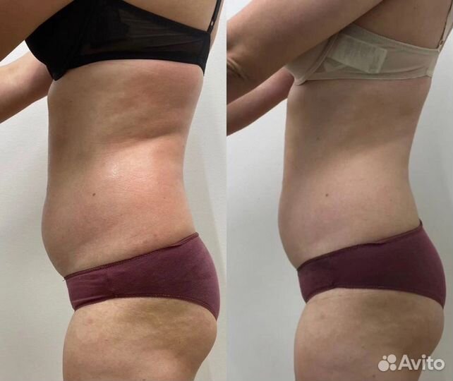 Массаж коррекция фигуры