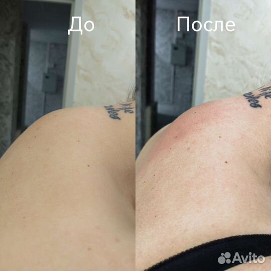 Костоправ/Правка Атланта