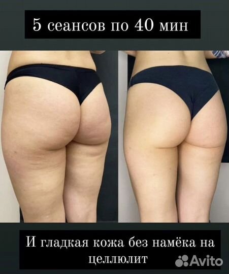 Похудеете аппаратный массаж Скетч