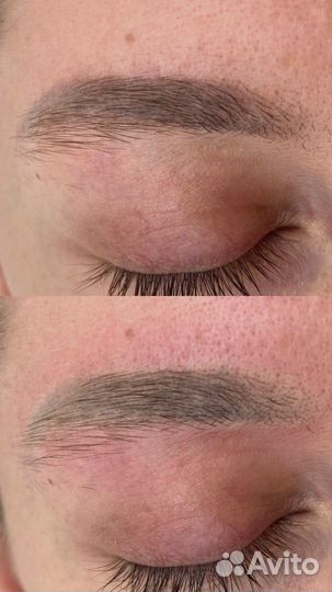 Лазерное удаления тату/татуажа/ /обучение/ модели