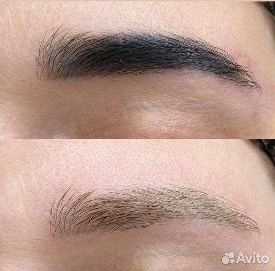 Удаление татуажа лазером