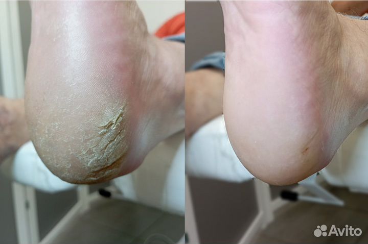 Лечебный (медицинский) педикюр подолог