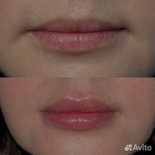Безыгольное увеличение губ