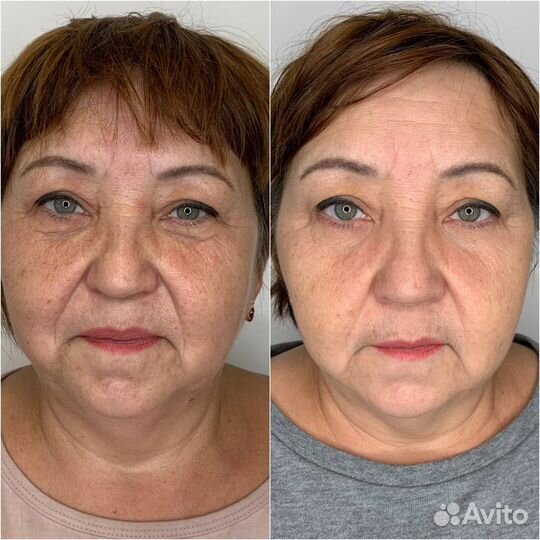 Услуги косметолога холодная плазма