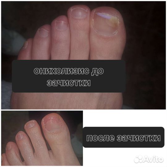 Подолог С мед. образованием, выезд на дом, педикюр