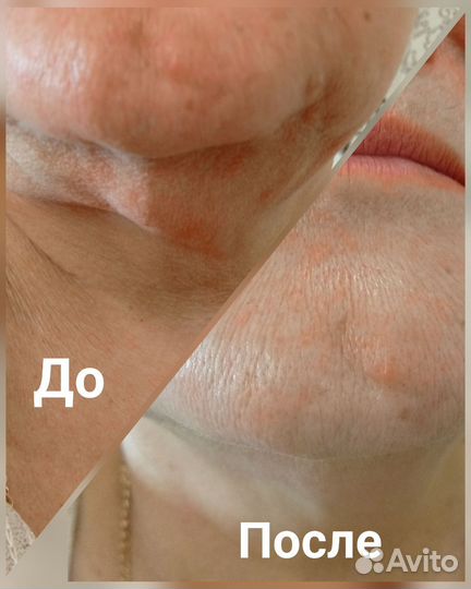 Экспресс-похудение