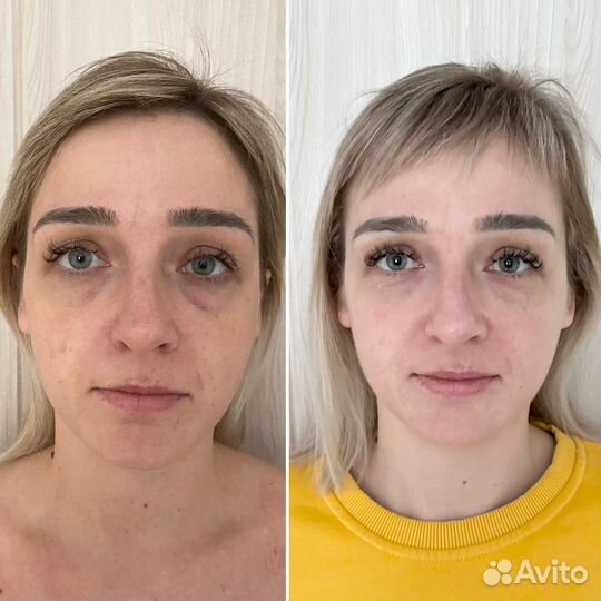 Бмс лица (подтяжка лица, объемные скулы, губы)