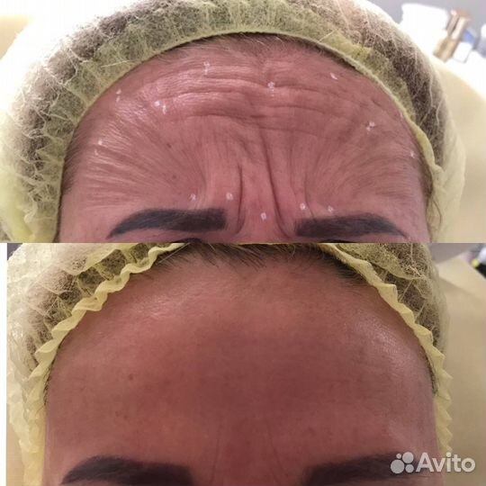 Ботокс для лица