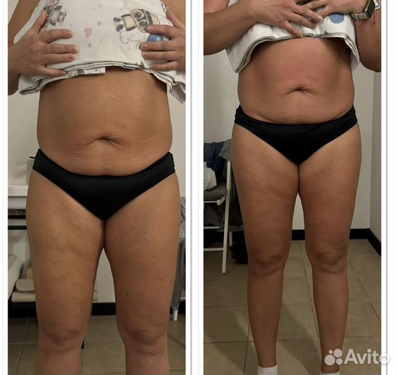 Послеродоваяя реабилитация ручная коррекция