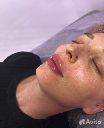 Увеличение губ и другие косметологические услуги