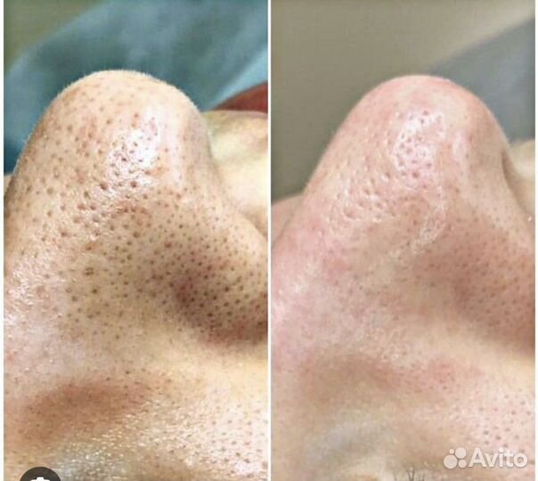 Для мужчин Механическая чистка лица