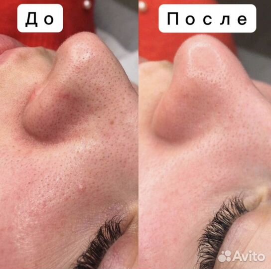 Косметолог Чистка лица Пилинг
