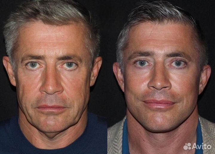 Программа омоложения для мужчин