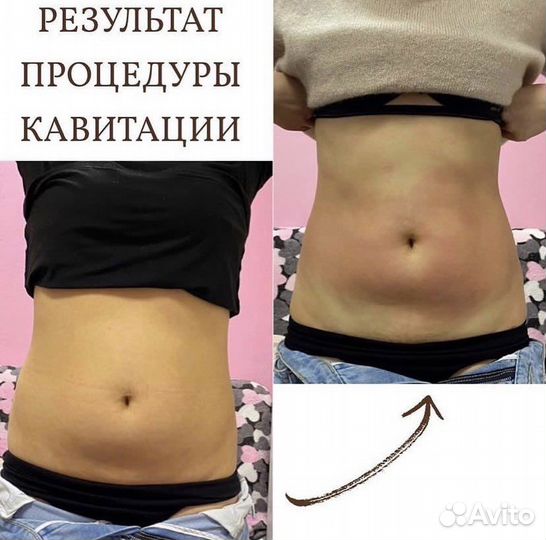 Ультразвуковая кавитация