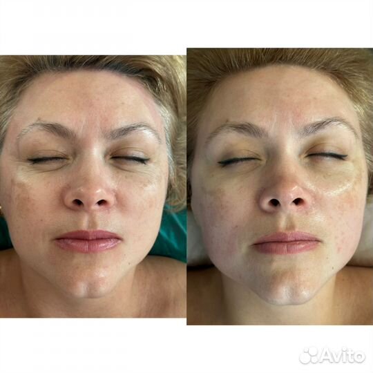 Холодная плазма