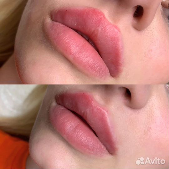 Моделирование губ увеличение